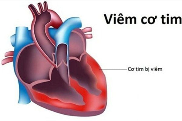cúm mùa có thể gây viêm cơ tim