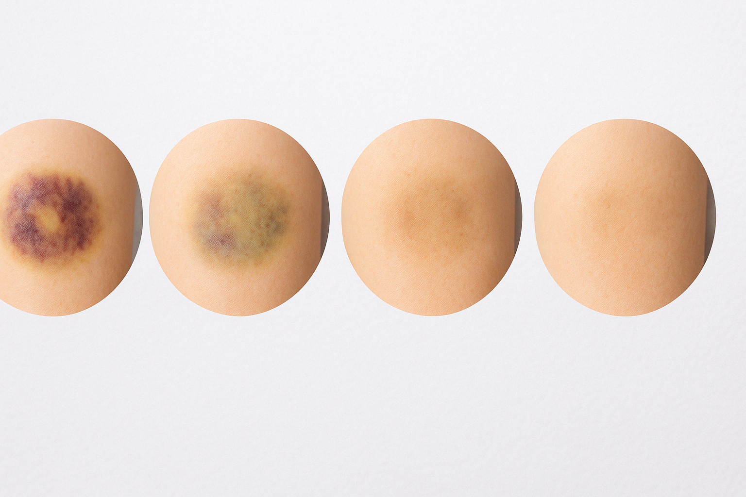 dấu hiệu vết bầm tím đã giảm