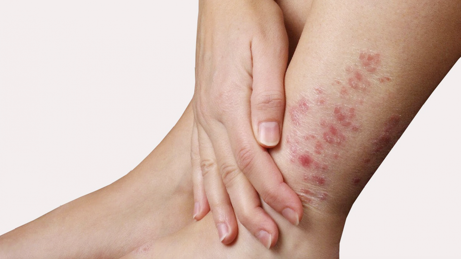 nồm ẩm gây bệnh ngoài da