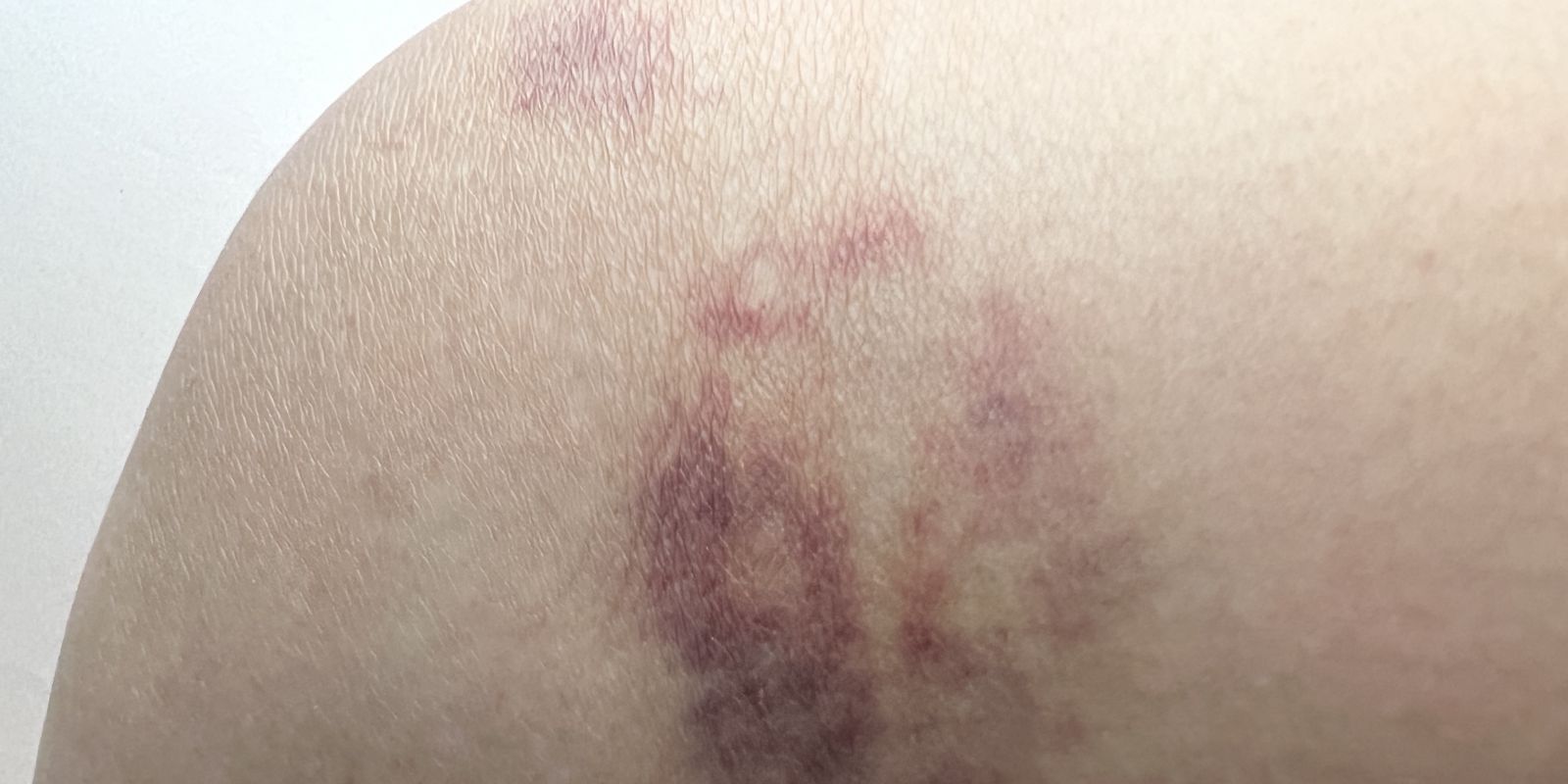 vết bầm sinh lý