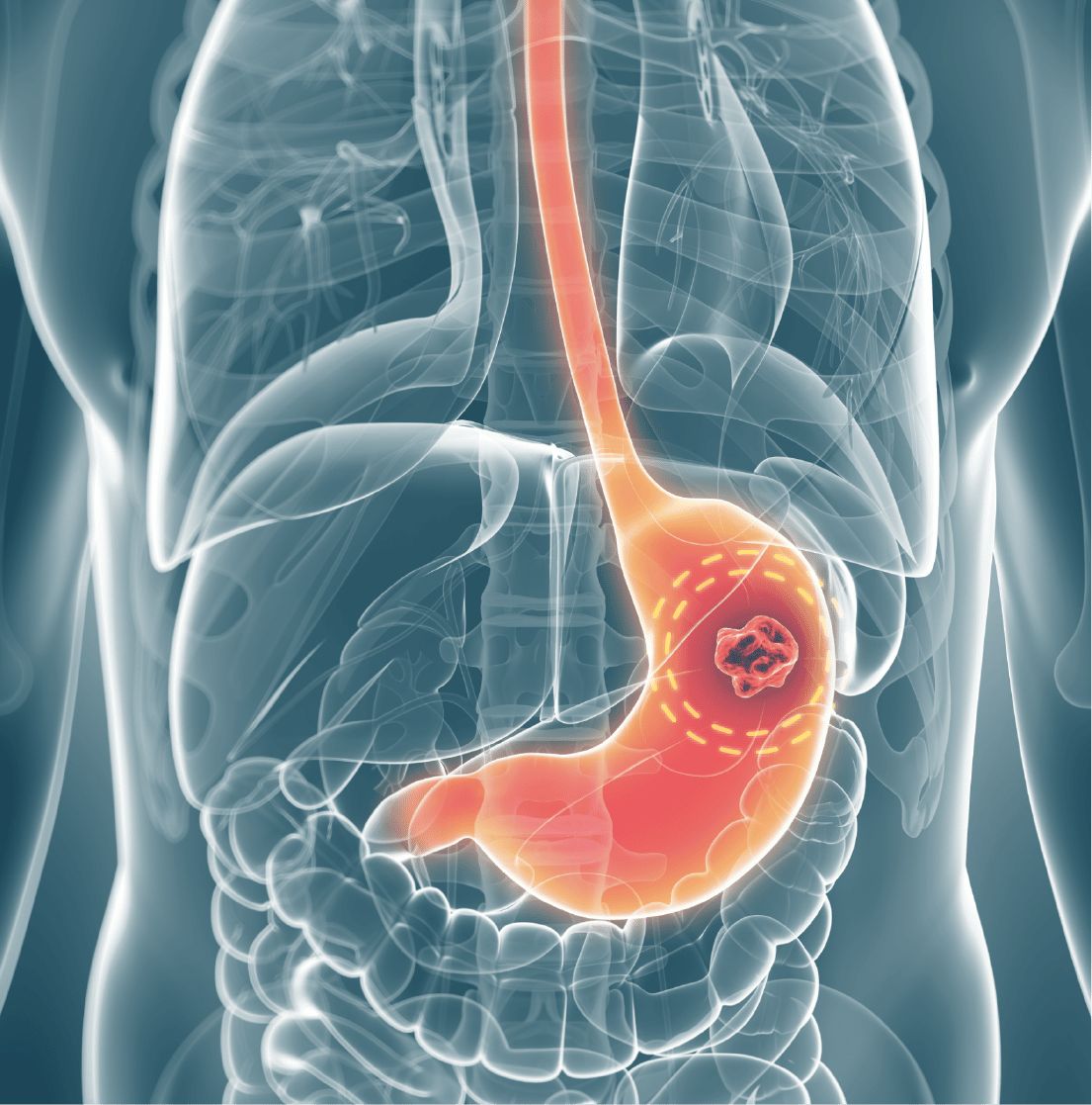 Bắp cải giúp ngăn ngừa ung thư