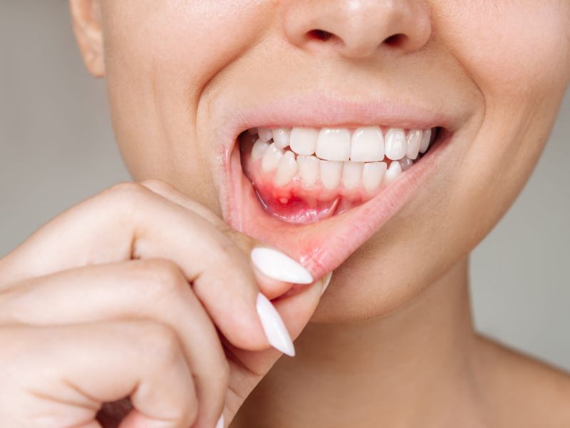 Bệnh nướu răng liên quan đến nguy cơ đột quỵ