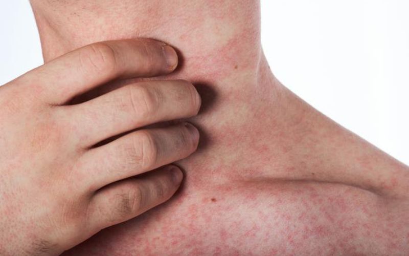 Dấu hiệu của sốt xuất huyết trở nặng