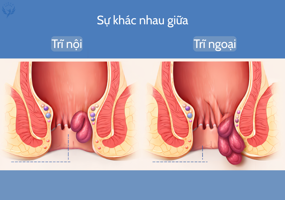 Sự khác nhau giữa trĩ nội và trĩ ngoại trong bệnh trĩ
