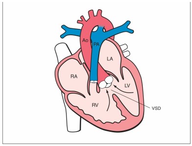 Cấu trúc tim bị tứ chứng Fallot ở thai nhi, gồm thông liên thất và hẹp động mạch phổi