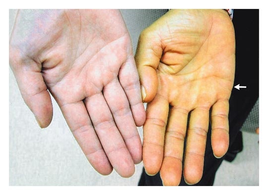 Vàng da là dấu hiệu của bệnh gan