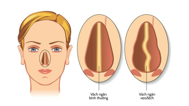 vẹo vách ngăn mũi